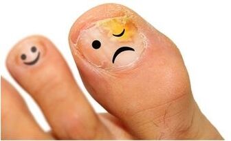 sarı ayak tırnağı mantarı