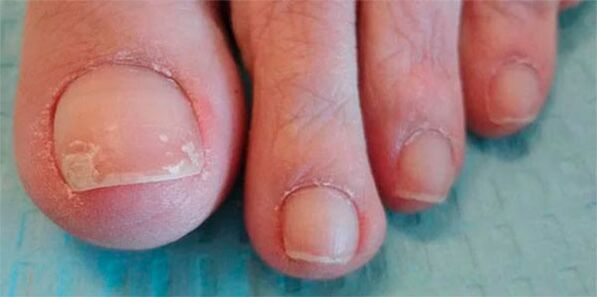 mantar bacaklarının aşamaları